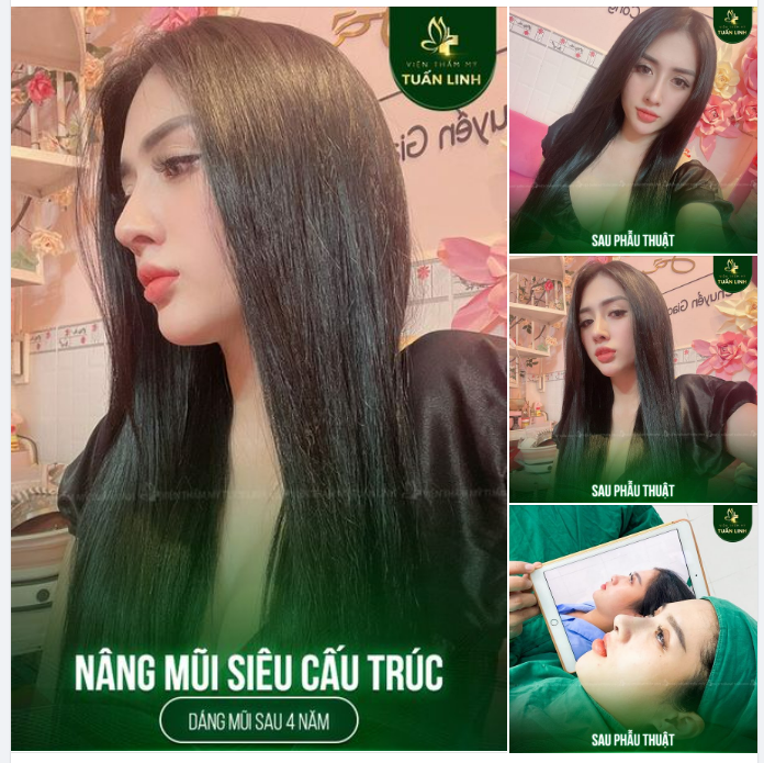 NÂNG MŨI SIÊU CẤU TRÚC - DÁNG MŨI SAU 4 NĂM ĐẸP HOÀN HẢO!!