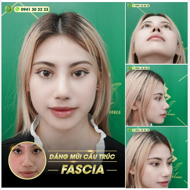 MŨI ĐẸP, BỀN NHỜ CÔNG NGHỆ FASCIA