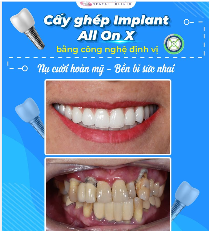 Răng hỏng, lung lay bởi tình trạng viêm nha chu nặng đã khiến cô L.T.H (50 tuổi, Huế) gặp nhiều vấn đề trong việc ăn uống cũng như cuộc sống hằng ngày.