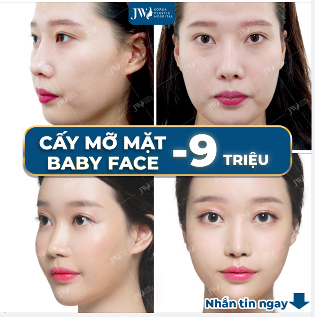 CẤY MỠ MẶT BABY FACE TRẺ HÓA TOÀN DIỆN KHUÔN MẶT