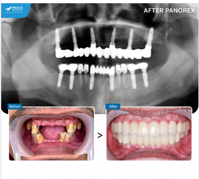 Ca lâm sàng trồng răng implant khôi phục chức năng ăn nhai và chức năng thẩm mỹ.