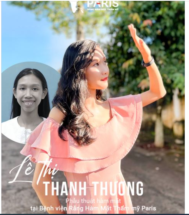 BẤT NGỜ với kết quả sau 6 tháng phẫu thuật hàm hô của Thanh Thương tại Hệ thống Paris