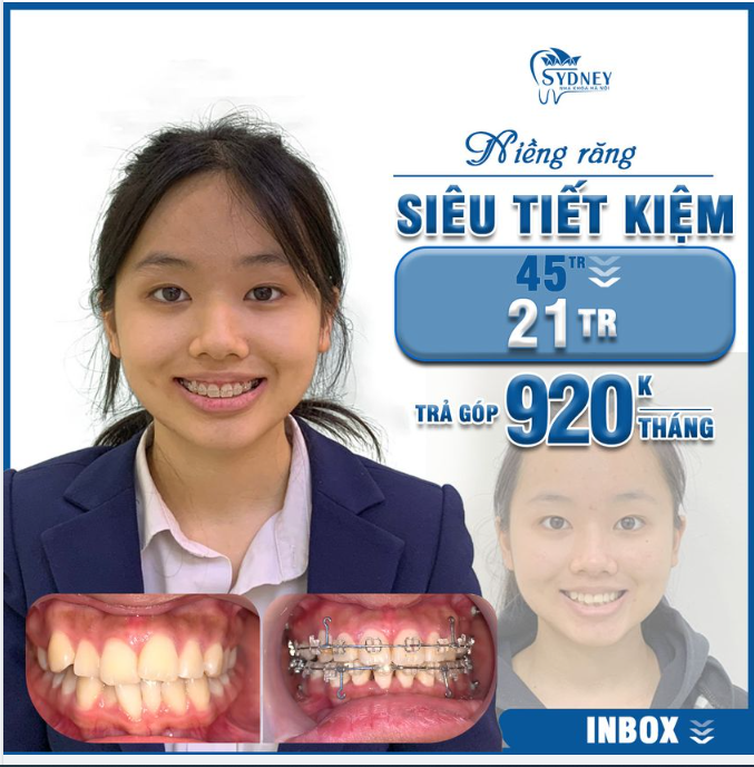 Khắc phục sai lệch khớp cắn hiệu quả bằng phương pháp niềng răng
