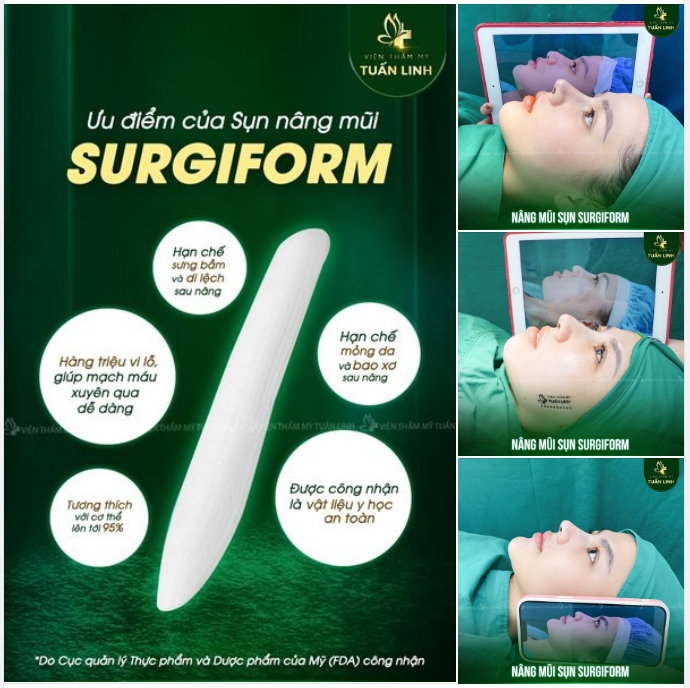 Hơn 70% khách hàng của Tuấn Linh lựa chọn sụn nâng mũi Surgiform - Vì sao??