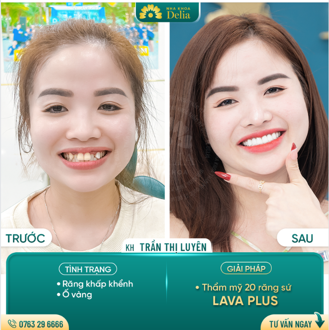 48H - Kiến tạo nụ cười hoàn hảo với 20 răng sứ Lava Plus