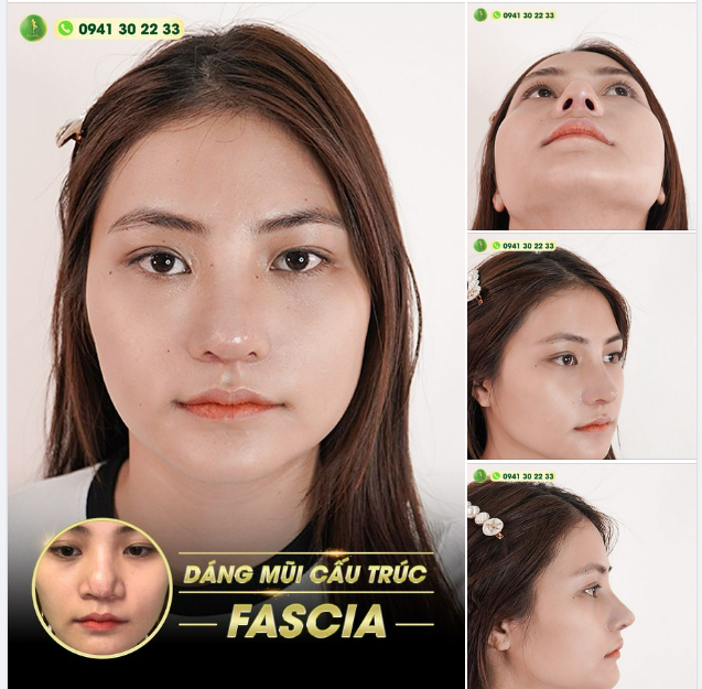 FEEDBACK KHOE DÁNG MŨI CẤU TRÚC FASCIA SAU 1 THÁNG THỰC HIỆN