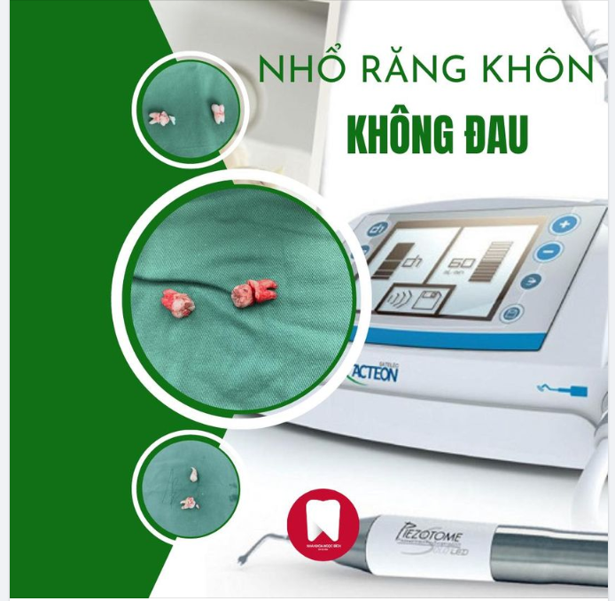 RĂNG KHÔN PHIỀN TOÁI - NHỔ LIỀN CHẲNG ĐAU!