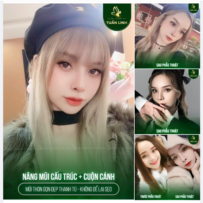 Nâng mũi cấu trúc + cuộn cánh mũi  Giải pháp tuyệt vời cho những chiếc mũi to bè muốn lên dáng thon gọn, đẹp tự nhiên, không để lại sẹo.