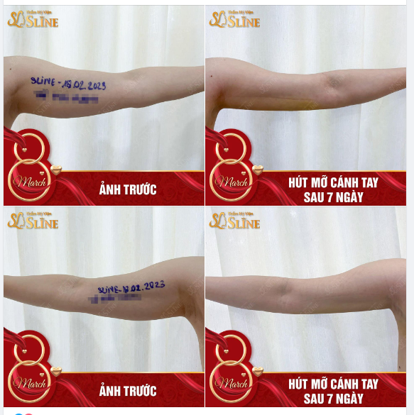 Hút mỡ cánh tay thon gọn tức thì.