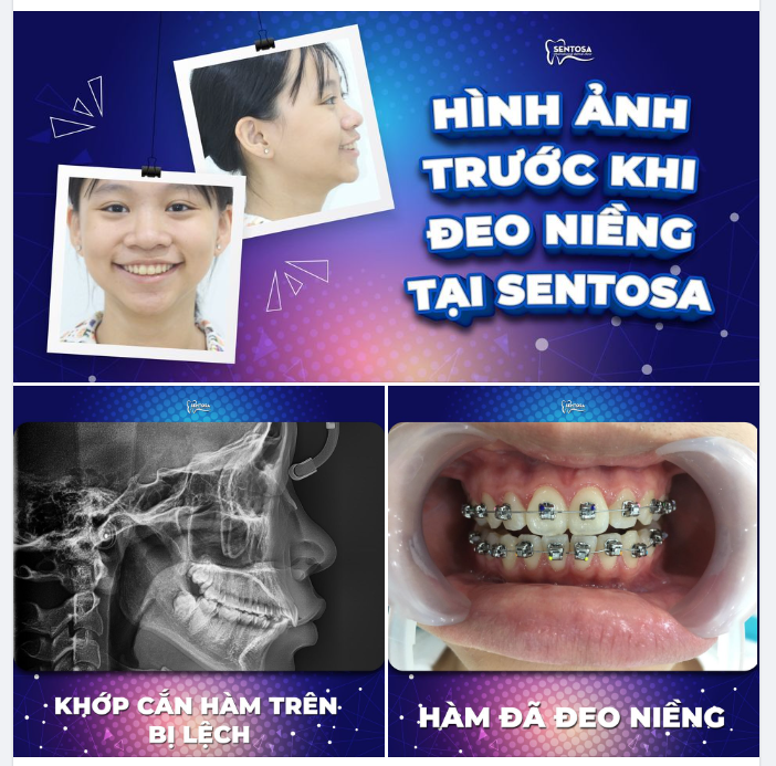 Kết quả thay đổi rõ rệt của bạn Ngọc Nhi sinh năm 2004