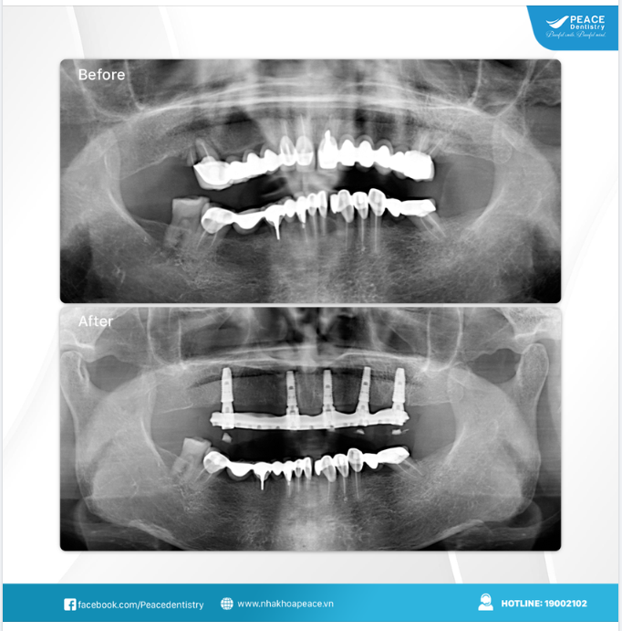 Ca lâm sàng: Thay cầu răng sứ dài, xuống cấp bằng All-on-5 Implant