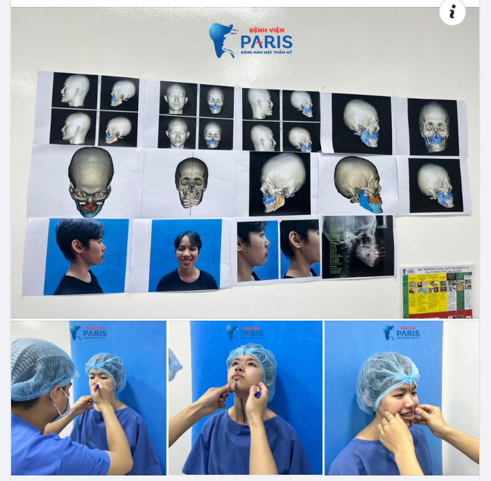 ĐO VẼ THẨM MỸ - BƯỚC "SỐNG CÒN" QUYẾT ĐỊNH MỘT GƯƠNG MẶT ĐẸP