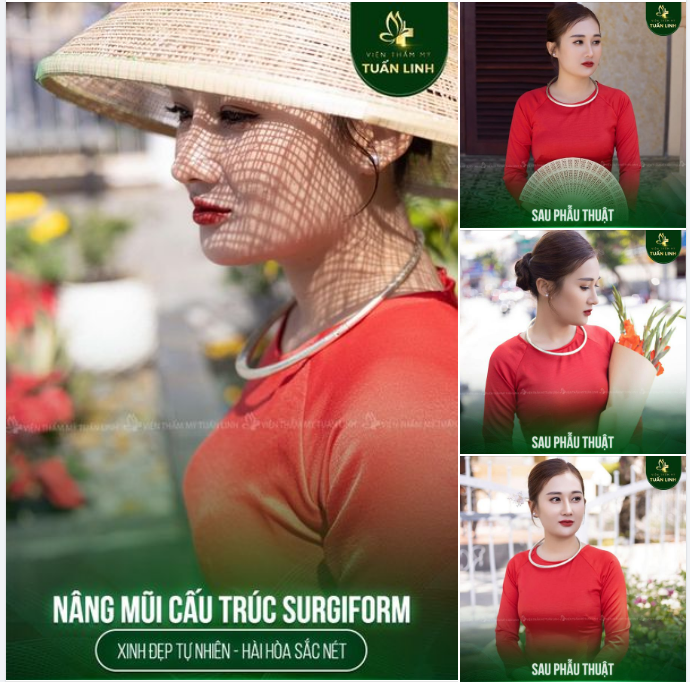 Chiếc mũi nâng cấu trúc Surgiform dáng Angel line cao tự nhiên, chuẩn phong thuỷ đúng tỉ lệ :