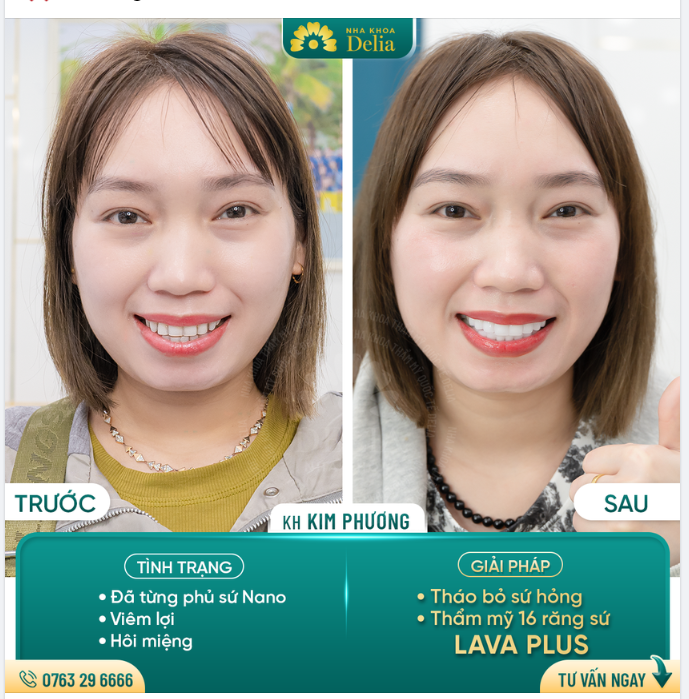 48H - Giải cứu thành công răng phủ sứ Nano cho chị Kim Phượng