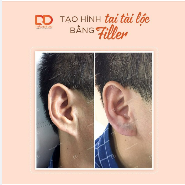 TẠO HÌNH TAI TÀI LỘC BẰNG FILLER