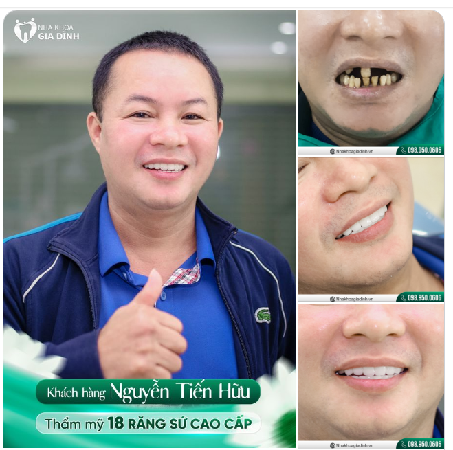 GIẬT MÌNH VỚI SỰ THAY ĐỔI SAU THẨM MỸ RĂNG