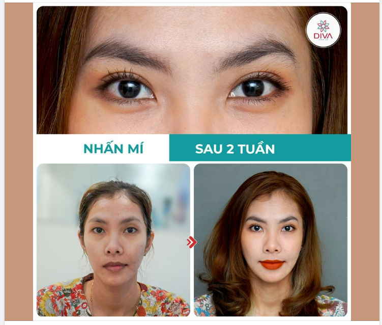 NHẤN MÍ MẮT VĨNH VIỄN TẠI DIVA: MẮT 2 MÍ CÂN ĐỐI, TỰ NHIÊN