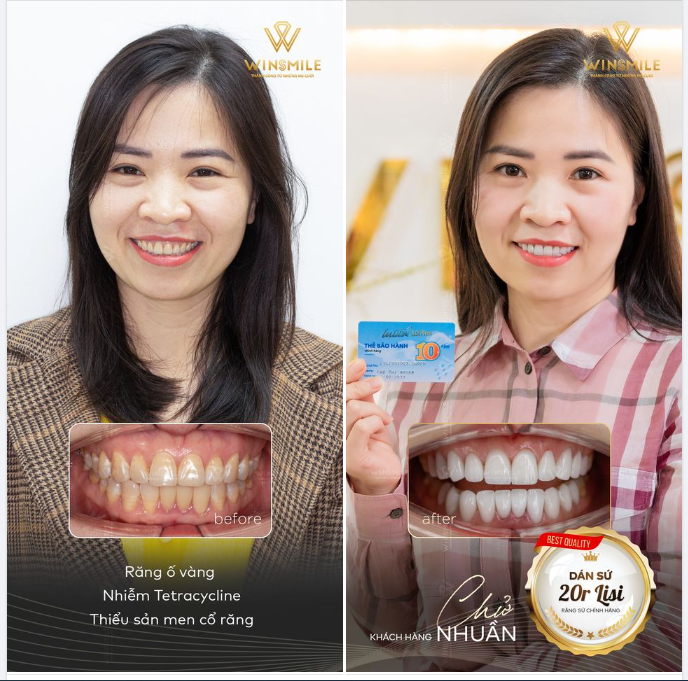 GIẢI PHÁP “KÉP” CHO HÀM RĂNG ĐỀU NHƯNG GẶP KHUYẾT ĐIỂM