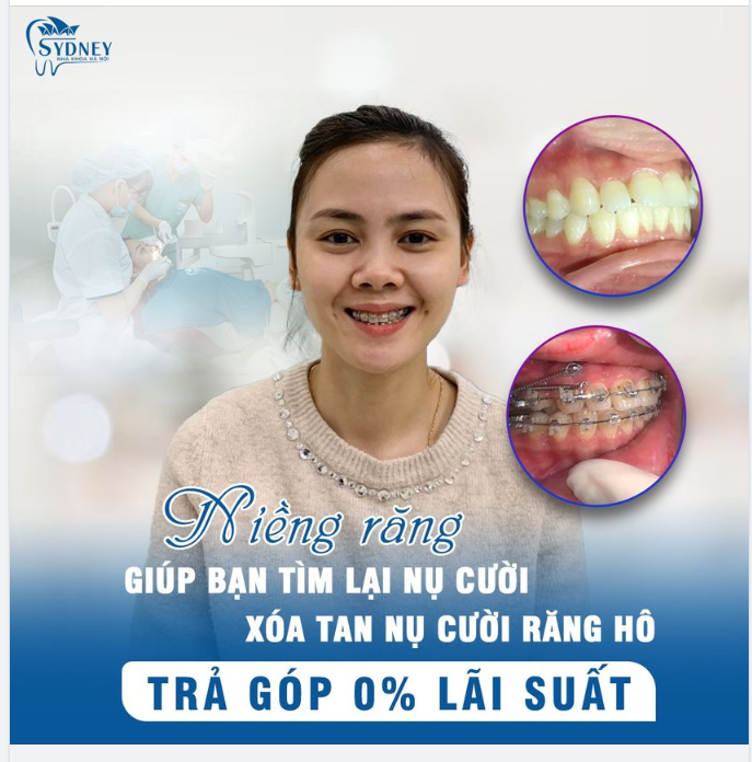 Tìm lại nụ cười tươi xinh với mắc cài trong suốt