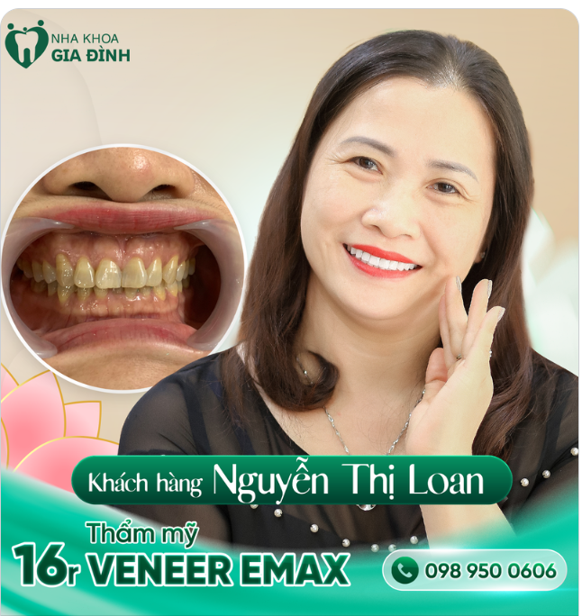 RĂNG ĐẸP NHƯ Ý CƯỜI LÀ TỰ TIN