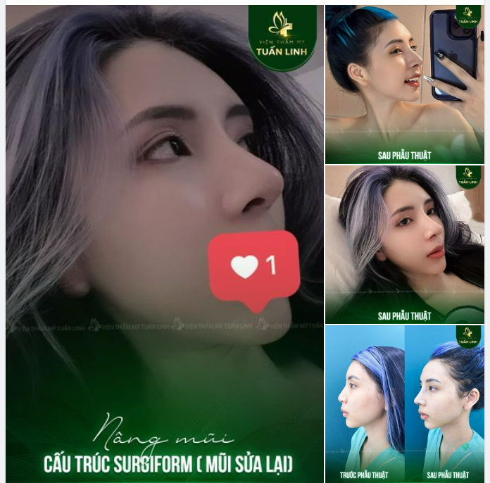 NÂNG MŨI CẤU TRÚC SURGIFORM ( MŨI SỬA LẠI ) - ĐẸP BẤT BẠI.