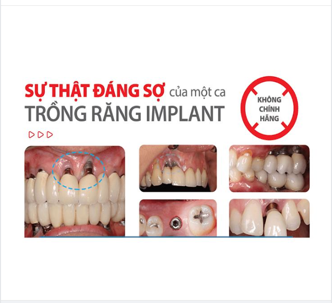 CẤY GHÉP IMPLANT GIÁ RẺ TỐT HAY KHÔNG?