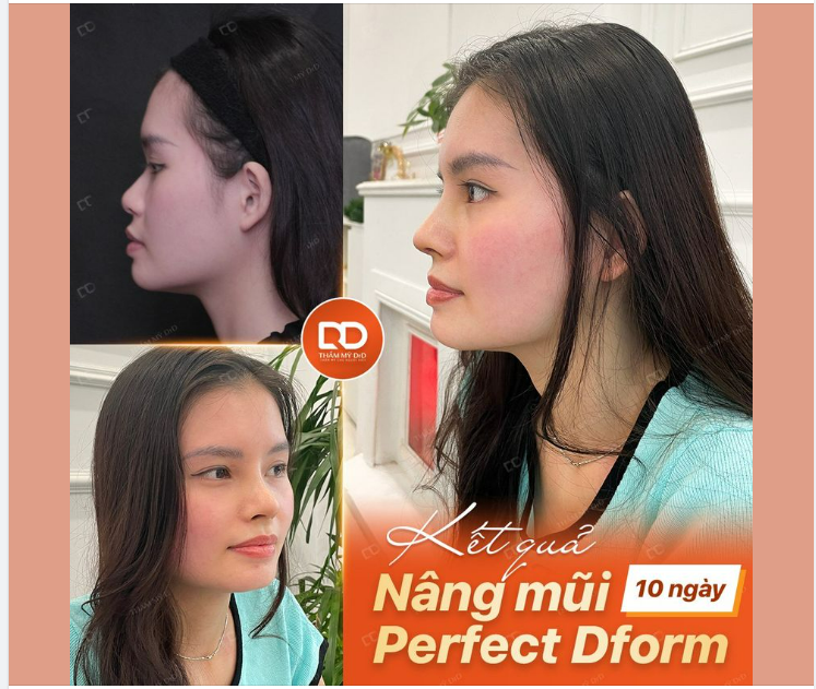 SỞ HỮU NÉT ĐẸP "LAI" TÂY SAU 10 NGÀY THỰC HIỆN