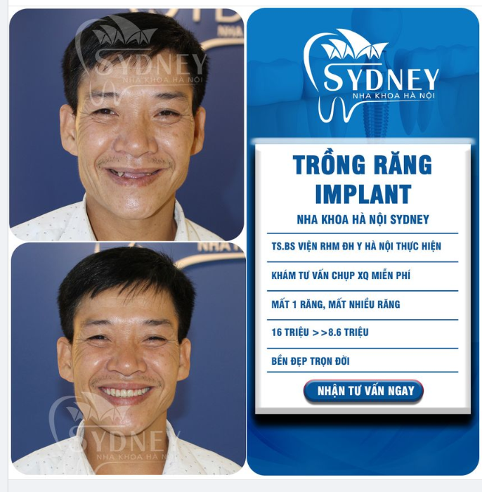 Cấy ghép Implant – cải thiện thẩm mỹ, ăn uống ngon hơn