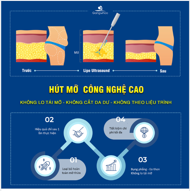 HÚT MỠ CÔNG NGHỆ CAO LIPO ULTRASOUND - KHÔNG LO TÁI MỠ