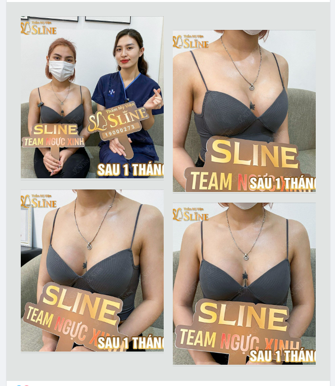 “NÂNG NGỰC XONG HỐI HẬN - NHƯNG LÀ HỐI HẬN VÌ KHÔNG LÀM SỚM HƠN”