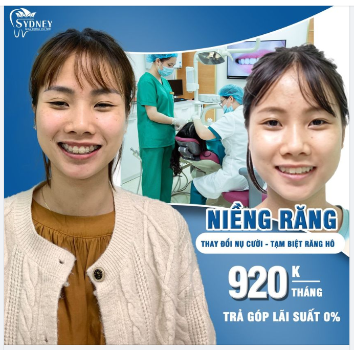 Niềng răng - Giải pháp khắc phục răng hô tốt nhất hiện nay.