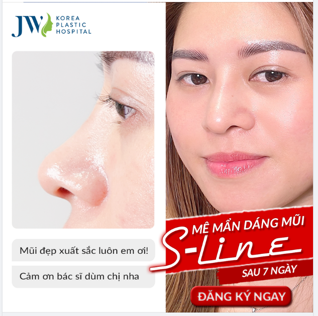 ĐẸP MÊ MẨN dáng mũi S-LINE siêu TỰ NHIÊN của chị khách hàng sau 7 ngày nâng mũi tại Bệnh viện JW