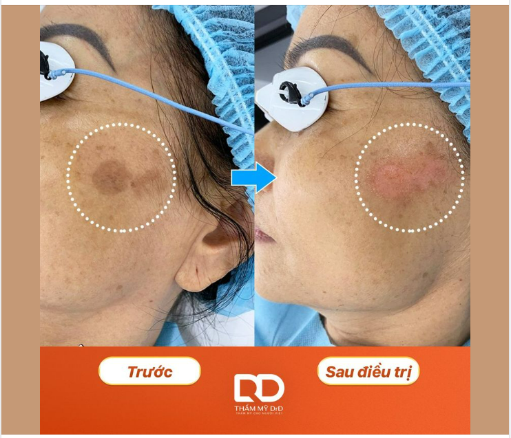 ĐỒI MỒI ĐIỀU TRỊ HẾT ĐƯỢC KHÔNG?