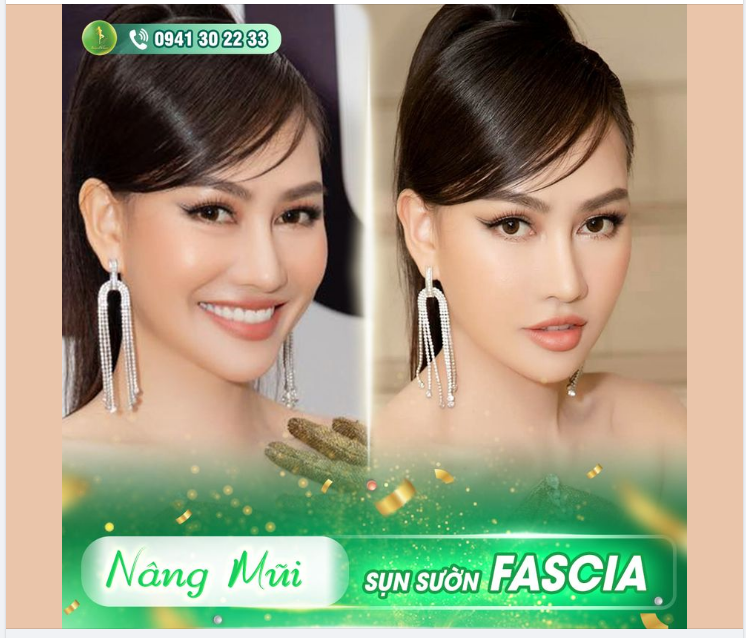 Á HẬU MC KIM DUYÊN THAY ĐỔI HOÀN TOÀN SAU NÂNG MŨI