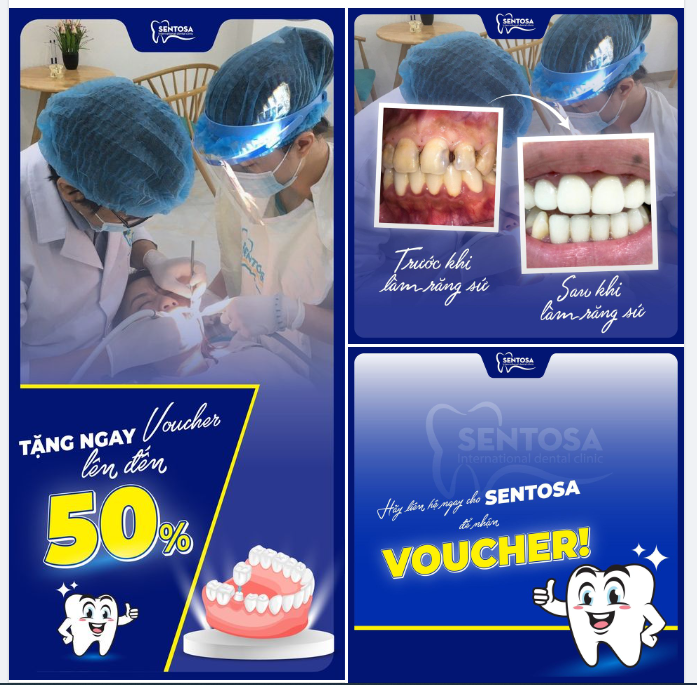 NỤ CƯỜI NHƯ Ý - CHI PHÍ TỐI ƯU VỚI RĂNG SỨ TẠI SENTOSA
