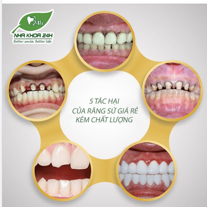 RĂNG SỨ GIÁ RẺ KÉM CHẤT LƯỢNG - TIỀN MẤT TẬT MANG