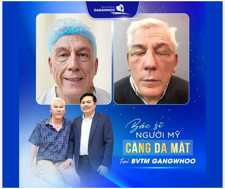 KẾT QUẢ SAU KHI CĂNG DA MẶT VÙNG MÁ TẠI BỆNH VIỆN GANGWHOO