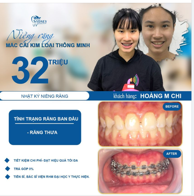 Niềng răng mắc cài kim loại thông minh và 5 ưu điểm nổi bật