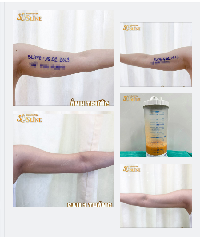 HÚT MỠ CÁNH TAY - GIẢM NGAY LÊN ĐẾN 30%.