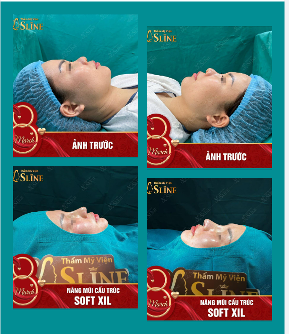 Đẹp ngỡ ngàng khi vừa nâng mũi cấu trúc SOFT XIL tại Sline!