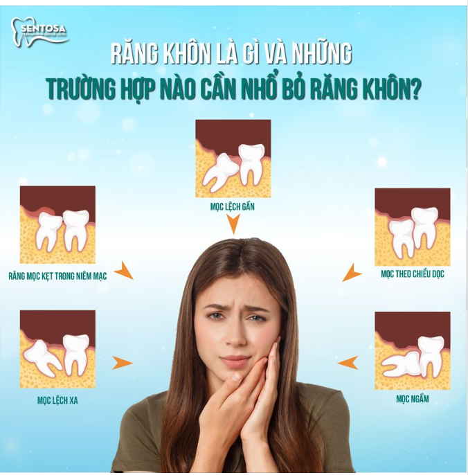 RĂNG KHÔN LÀ GÌ VÀ NHỮNG TRƯỜNG HỢP NÀO NÊN NHỔ BỎ