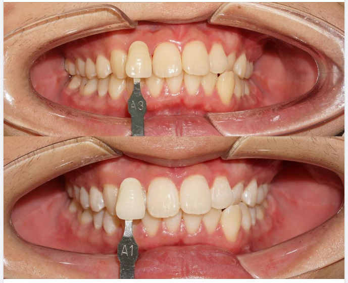 Một ca tẩy trắng răng bằng hệ thống ZOOM chi nhánh Tôn Dật Tiên, bác sĩ Dũng điều trị