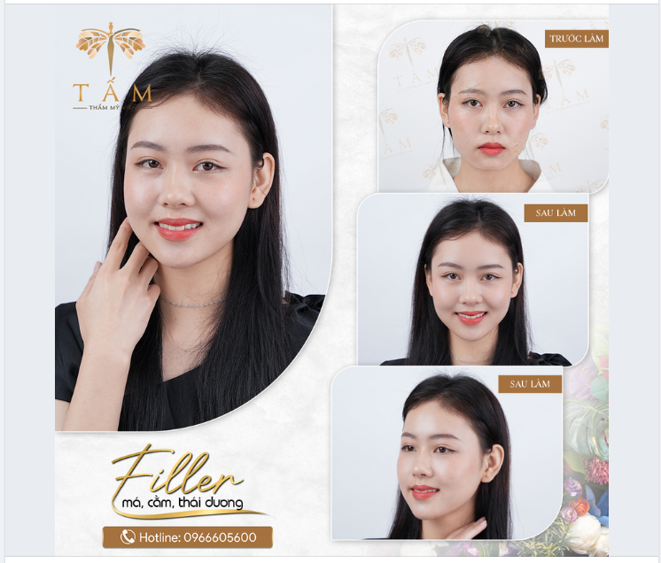Lý do khiến khách hàng khi đến Tấm lựa chọn COMBO FILLER để làm đẹp