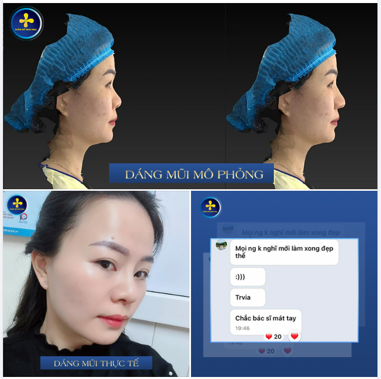 DÁNG MŨI MÔ PHỎNG VÀ KẾT QUẢ THỰC TẾ SAU 3 TUẦN