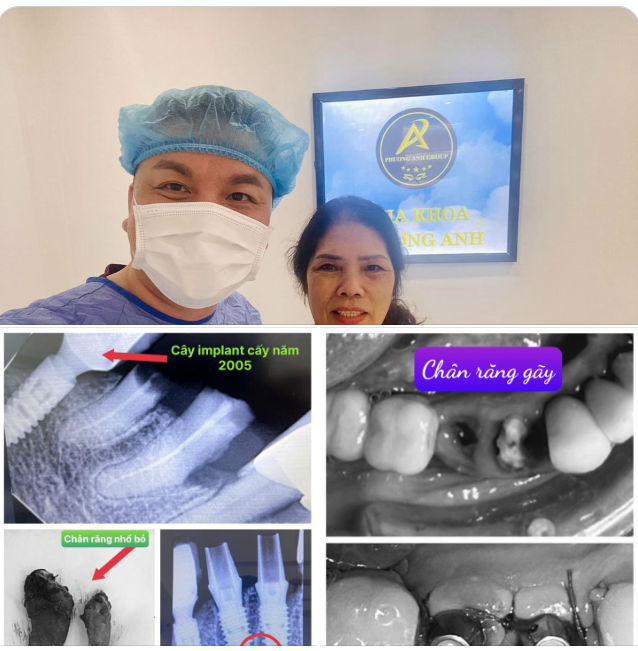 TRỒNG RĂNG IMPLANT TỨC THÌ - RÚT NGẮN THỜI GIAN HOÀN THIỆN