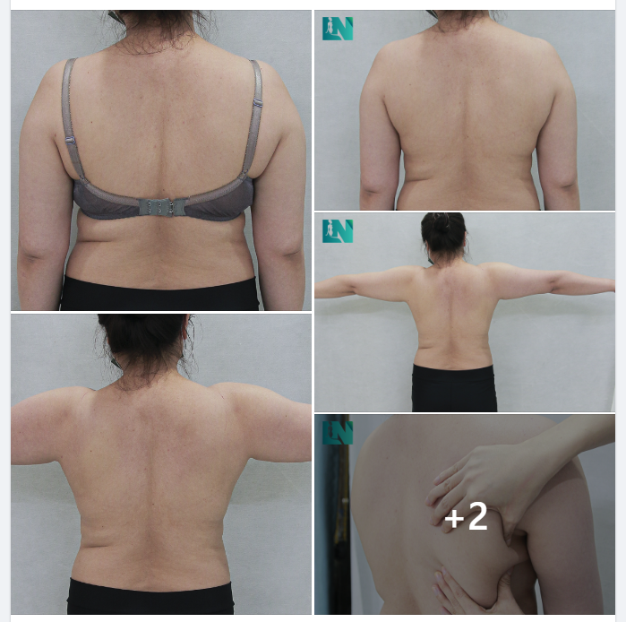  HÚT MỠ TẠO DÁNG THẨM MỸ VÙNG THÂN TRÊN: TAY, LƯNG, NÁCH CHO CHỊ KH (SN 1984) ĐẾN TỪ HẬU GIANG.