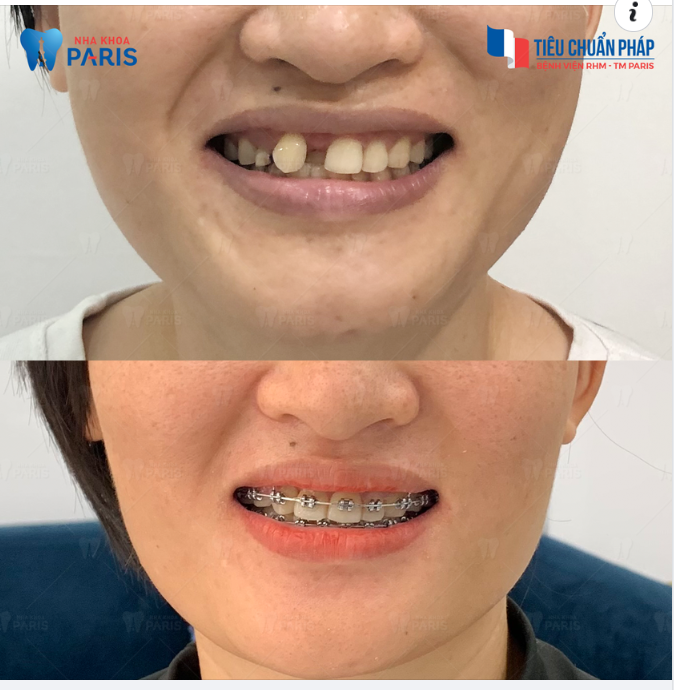 Niềng Răng Sao Cho Đáng Tiền