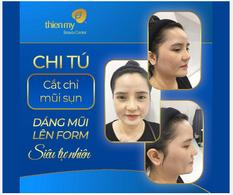 Hình ảnh khách hàng sau khi Cắt chỉ Mũi Sụn tại Thiện Mỹ quá tự nhiên luôn ạ!
