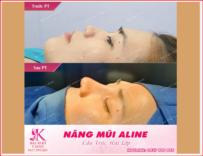 Kết quả vừa mới phẫu thuật Nâng mũi xong nha Cả nhà!