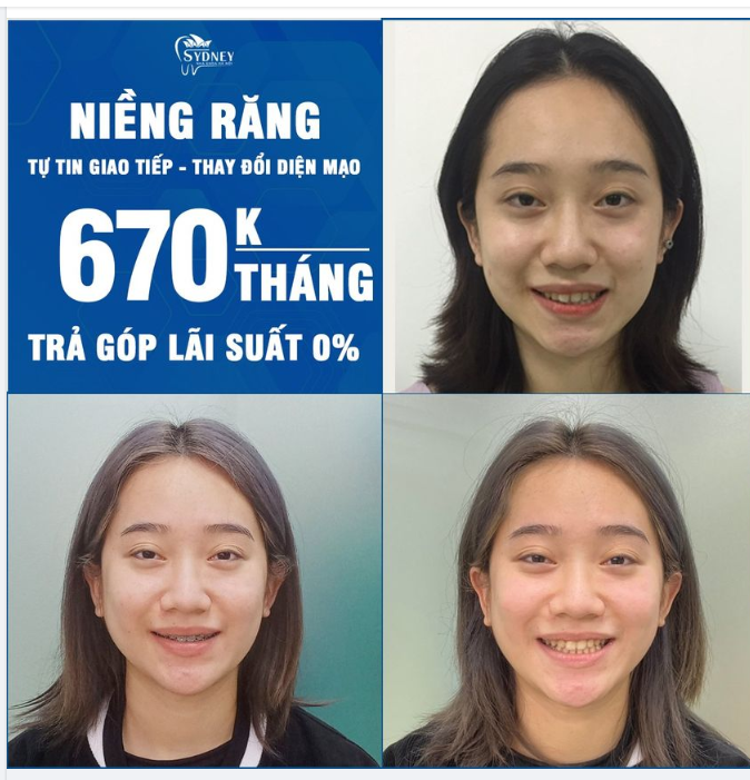 Ưu đãi đặc biệt tháng 3: Niềng răng chỉ 670k/tháng